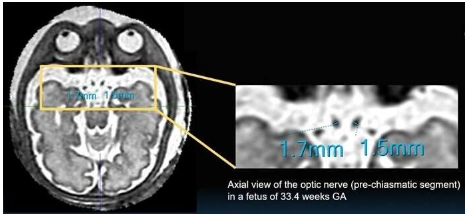 3D SVR MRI 有助于描绘胎儿视神经通路