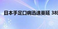 日本手足口病迅速蔓延 38地指标超警戒值